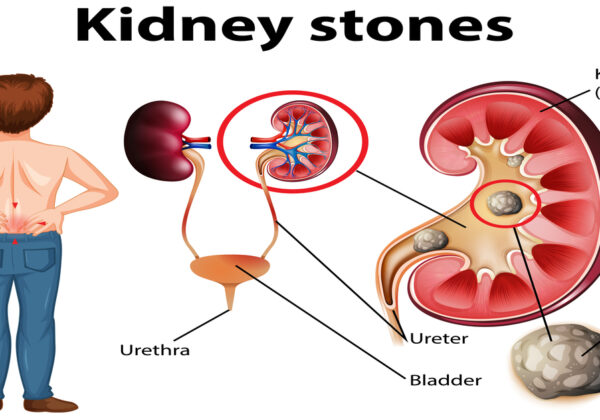 A Guide to Diagnosing & Treating Kidney Stones