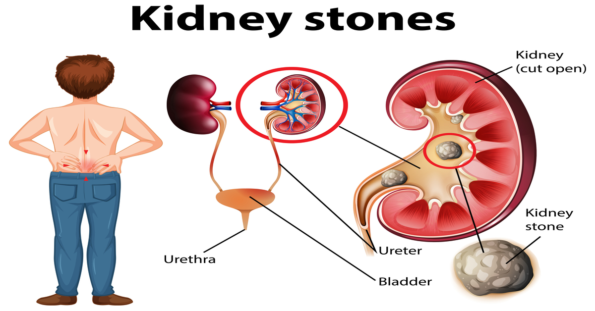 Kidney Stones - Healthlifenews