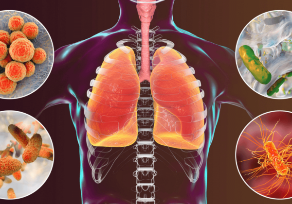 Pneumonia: Lung Infection Disease