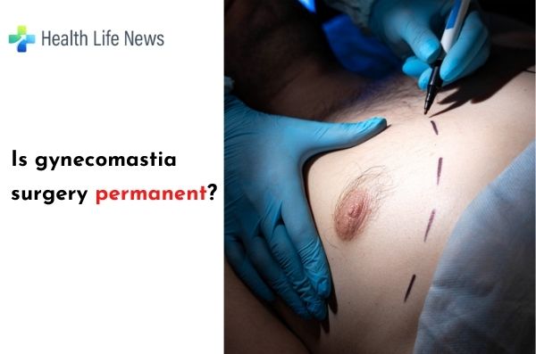Is gynecomastia surgery permanent?