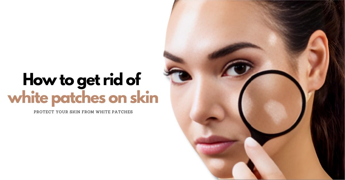 How to cure white patches on skin?
