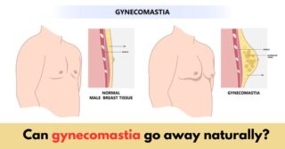 Can Gynecomastia Go Away Naturally? - Healthlifenews